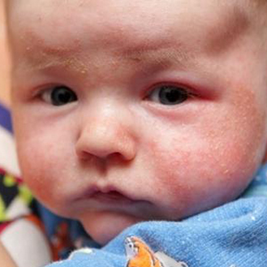 Eczeem en voedselallergieën bij baby’s: Wat is het verband?